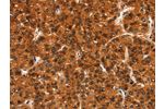 The image on the left is immunohistochemistry of paraffin-embedded Human liver cancer tissue using CSB-PA217827(BFAR Antibody) at dilution 1/20, on the right is treated with synthetic peptide. (Original magnification: 
