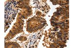 The image on the left is immunohistochemistry of paraffin-embedded Human colon cancer tissue using CSB-PA217880(ADAP1 Antibody) at dilution 1/60, on the right is treated with fusion protein. (Original magnification: 
