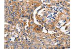 The image on the left is immunohistochemistry of paraffin-embedded Human cervical cancer tissue using CSB-PA218378(CDH1 Antibody) at dilution 1/100, on the right is treated with synthetic peptide. (Original magnification: 