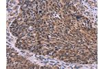 The image on the left is immunohistochemistry of paraffin-embedded Human ovarian cancer tissue using CSB-PA218975(CDC5L Antibody) at dilution 1/30, on the right is treated with fusion protein. (Original magnification: 