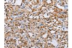 The image on the left is immunohistochemistry of paraffin-embedded Human thyroid cancer tissue using CSB-PA219113(ATXN1 Antibody) at dilution 1/40, on the right is treated with fusion protein. (Original magnification: 