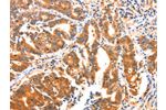 The image on the left is immunohistochemistry of paraffin-embedded Human gastic cancer tissue using CSB-PA219365(AK5 Antibody) at dilution 1/60, on the right is treated with synthetic peptide. (Original magnification: 