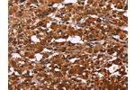 The image on the left is immunohistochemistry of paraffin-embedded Human thyroid cancer tissue using CSB-PA219850(ART5 Antibody) at dilution 1/50, on the right is treated with fusion protein. (Original magnification: 