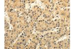 The image on the left is immunohistochemistry of paraffin-embedded Human liver cancer tissue using CSB-PA219867(GAD1 Antibody) at dilution 1/35, on the right is treated with synthetic peptide. (Original magnification: 