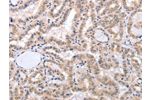 The image on the left is immunohistochemistry of paraffin-embedded Human thyroid cancer tissue using CSB-PA221364(FADD Antibody) at dilution 1/50, on the right is treated with fusion protein. (Original magnification: 