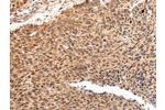 The image on the left is immunohistochemistry of paraffin-embedded Human lung cancer tissue using CSB-PA221484(ATF1 Antibody) at dilution 1/35, on the right is treated with synthetic peptide. (Original magnification: 