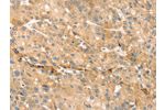 The image on the left is immunohistochemistry of paraffin-embedded Human liver cancer tissue using CSB-PA222058(EVA1A Antibody) at dilution 1/30, on the right is treated with synthetic peptide. (Original magnification: 