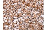 The image on the left is immunohistochemistry of paraffin-embedded Human thyroid cancer tissue using CSB-PA222690(GCGR Antibody) at dilution 1/40, on the right is treated with synthetic peptide. (Original magnification: 