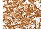 The image on the left is immunohistochemistry of paraffin-embedded Human thyroid cancer tissue using CSB-PA223164(COL4A3BP Antibody) at dilution 1/50, on the right is treated with fusion protein. (Original magnification: 