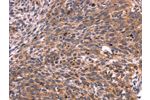 The image on the left is immunohistochemistry of paraffin-embedded Human cervical cancer tissue using CSB-PA223350(CRK Antibody) at dilution 1/40, on the right is treated with fusion protein. (Original magnification: 