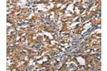 The image on the left is immunohistochemistry of paraffin-embedded Human thyroid cancer tissue using CSB-PA223476(DDR2 Antibody) at dilution 1/40, on the right is treated with synthetic peptide. (Original magnification: 