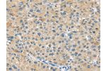 The image on the left is immunohistochemistry of paraffin-embedded Human liver cancer tissue using CSB-PA223592(ABCC2 Antibody) at dilution 1/45, on the right is treated with synthetic peptide. (Original magnification: 