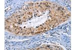 The image on the left is immunohistochemistry of paraffin-embedded Human cervical cancer tissue using CSB-PA223753(BAG1 Antibody) at dilution 1/20, on the right is treated with fusion protein. (Original magnification: 