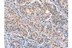 The image on the left is immunohistochemistry of paraffin-embedded Human gastic cancer tissue using CSB-PA223936(ELOVL6 Antibody) at dilution 1/40, on the right is treated with synthetic peptide. (Original magnification: 