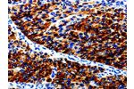 The image on the left is immunohistochemistry of paraffin-embedded Human renal cancer tissue using CSB-PA224008(AGR2 Antibody) at dilution 1/10, on the right is treated with fusion protein. (Original magnification: 
