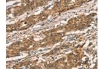 The image on the left is immunohistochemistry of paraffin-embedded Human gastic cancer tissue using CSB-PA224134(CXCR6 Antibody) at dilution 1/30, on the right is treated with fusion protein. (Original magnification: 