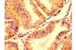 IHC image of CSB-PA22439A0Rb diluted at 1:500 and staining in paraffin-embedded human endometrial cancer performed on a Leica BondTM system. After dewaxing and hydration, antigen retrieval was mediated by high pressure in a citrate buffer (pH 6.0). Sectio