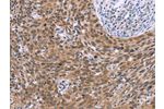 The image on the left is immunohistochemistry of paraffin-embedded Human cervical cancer tissue using CSB-PA224597(GLYR1 Antibody) at dilution 1/30, on the right is treated with synthetic peptide. (Original magnification: 