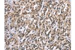 The image on the left is immunohistochemistry of paraffin-embedded Human esophagus cancer tissue using CSB-PA225115(ADNP Antibody) at dilution 1/15, on the right is treated with synthetic peptide. (Original magnification: 