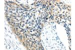 The image on the left is immunohistochemistry of paraffin-embedded Human esophagus cancer tissue using CSB-PA225304(AEBP1 Antibody) at dilution 1/25, on the right is treated with synthetic peptide. (Original magnification: 