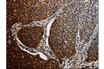 The image on the left is immunohistochemistry of paraffin-embedded Human renal cancer tissue using CSB-PA225375(BID Antibody) at dilution 1/25, on the right is treated with fusion protein. (Original magnification: 