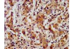 IHC image of CSB-PA22559A0Rb diluted at 1:200 and staining in paraffin-embedded human liver cancer performed on a Leica BondTM system. After dewaxing and hydration, antigen retrieval was mediated by high pressure in a citrate buffer (pH 6.0). Section was 