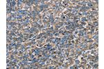 The image on the left is immunohistochemistry of paraffin-embedded Human ovarian cancer tissue using CSB-PA225650(APOA1 Antibody) at dilution 1/25, on the right is treated with fusion protein. (Original magnification: 