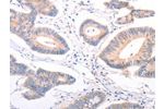 The image on the left is immunohistochemistry of paraffin-embedded Human colon cancer tissue using CSB-PA225678(F9 Antibody) at dilution 1/45, on the right is treated with fusion protein. (Original magnification: 