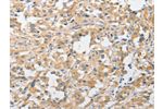 The image on the left is immunohistochemistry of paraffin-embedded Human thyroid cancer tissue using CSB-PA227449(APPBP2 Antibody) at dilution 1/30, on the right is treated with fusion protein. (Original magnification: 