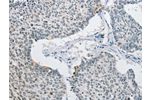 The image on the left is immunohistochemistry of paraffin-embedded Human lung cancer tissue using CSB-PA227771(AP2M1 Antibody) at dilution 1/15, on the right is treated with fusion protein. (Original magnification: 