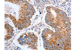 The image on the left is immunohistochemistry of paraffin-embedded Human colon cancer tissue using CSB-PA228012(CLDN10 Antibody) at dilution 1/50, on the right is treated with synthetic peptide. (Original magnification: 