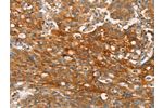 The image on the left is immunohistochemistry of paraffin-embedded Human gastic cancer tissue using CSB-PA228236(CLDN11 Antibody) at dilution 1/25, on the right is treated with synthetic peptide. (Original magnification: 