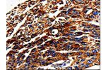 The image on the left is immunohistochemistry of paraffin-embedded Human lung cancer tissue using CSB-PA228295(ALPL Antibody) at dilution 1/25, on the right is treated with fusion protein. (Original magnification: 