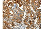 The image on the left is immunohistochemistry of paraffin-embedded Human gastic cancer tissue using CSB-PA229032(CEACAM5 Antibody) at dilution 1/20, on the right is treated with fusion protein. (Original magnification: 