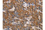 The image on the left is immunohistochemistry of paraffin-embedded Human liver cancer tissue using CSB-PA229044(APLNR Antibody) at dilution 1/50, on the right is treated with fusion protein. (Original magnification: 