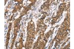 The image on the left is immunohistochemistry of paraffin-embedded Human gastic cancer tissue using CSB-PA229519(DSC2 Antibody) at dilution 1/25, on the right is treated with synthetic peptide. (Original magnification: 
