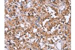 The image on the left is immunohistochemistry of paraffin-embedded Human thyroid cancer tissue using CSB-PA229662(APAF1 Antibody) at dilution 1/20, on the right is treated with synthetic peptide. (Original magnification: 