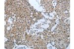 The image on the left is immunohistochemistry of paraffin-embedded Human breast cancer tissue using CSB-PA229849(CCL15 Antibody) at dilution 1/25, on the right is treated with synthetic peptide. (Original magnification: 