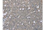 The image on the left is immunohistochemistry of paraffin-embedded Human ovarian cancer tissue using CSB-PA229873(BMX Antibody) at dilution 1/30, on the right is treated with fusion protein. (Original magnification: 