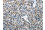The image on the left is immunohistochemistry of paraffin-embedded Human liver cancer tissue using CSB-PA229924(EPHB3 Antibody) at dilution 1/50, on the right is treated with synthetic peptide. (Original magnification: 