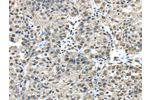 The image on the left is immunohistochemistry of paraffin-embedded Human breast cancer tissue using CSB-PA229936(FUS Antibody) at dilution 1/45, on the right is treated with fusion protein. (Original magnification: 