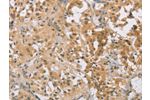 The image on the left is immunohistochemistry of paraffin-embedded Human thyroid cancer tissue using CSB-PA230952(CENPF Antibody) at dilution 1/30, on the right is treated with synthetic peptide. (Original magnification: 