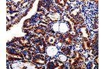 The image is immunohistochemistry of paraffin-embedded Human thyroid cancer tissue using CSB-PA230953(AFP Antibody) at dilution 1/40. (Original magnification: 