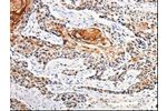 The image is immunohistochemistry of paraffin-embedded Human esophagus cancer tissue using CSB-PA231310(ANGPTL4 Antibody) at dilution 1/25. (Original magnification: 200)