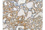 The image on the left is immunohistochemistry of paraffin-embedded Human thyroid cancer tissue using CSB-PA231814(AANAT Antibody) at dilution 1/40, on the right is treated with fusion protein. (Original magnification: 