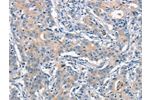 The image on the left is immunohistochemistry of paraffin-embedded Human gastic cancer tissue using CSB-PA231989(ANAPC1 Antibody) at dilution 1/15, on the right is treated with synthetic peptide. (Original magnification: 