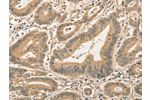 The image on the left is immunohistochemistry of paraffin-embedded Human colon cancer tissue using CSB-PA232587(CDCA8 Antibody) at dilution 1/40, on the right is treated with fusion protein. (Original magnification: 