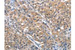 The image on the left is immunohistochemistry of paraffin-embedded Human lung cancer tissue using CSB-PA232631(ARFGAP1 Antibody) at dilution 1/30, on the right is treated with fusion protein. (Original magnification: 