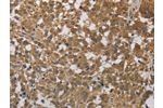 The image on the left is immunohistochemistry of paraffin-embedded Human thyroid cancer tissue using CSB-PA232766(CYB5A Antibody) at dilution 1/40, on the right is treated with fusion protein. (Original magnification: 
