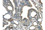 The image on the left is immunohistochemistry of paraffin-embedded Human thyroid cancer tissue using CSB-PA233073(ERP44 Antibody) at dilution 1/30, on the right is treated with fusion protein. (Original magnification: 